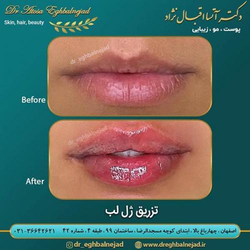 تزریق-ژل-لب-20