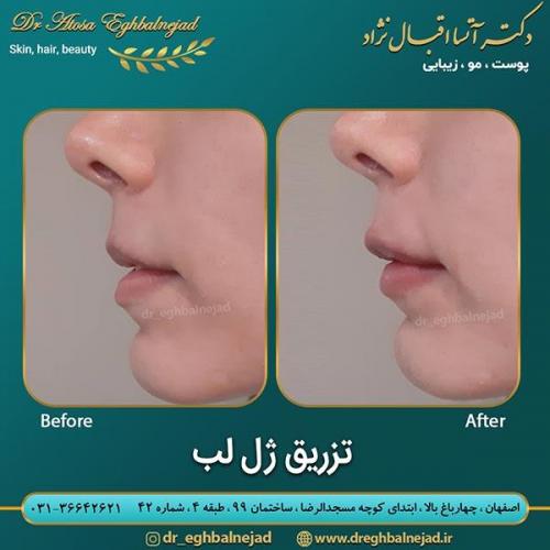 تزریق-ژل-لب-21
