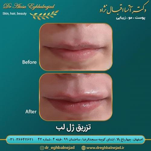 تزریق-ژل-لب-22