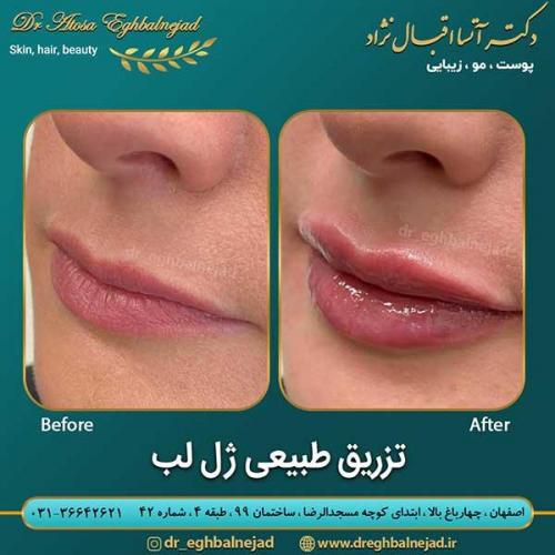 تزریق-ژل-لب-24