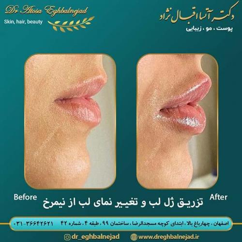 تزریق-ژل-لب-25
