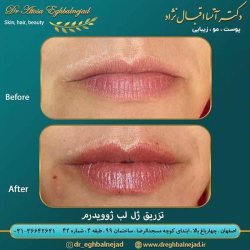 تزریق-ژل-لب-26