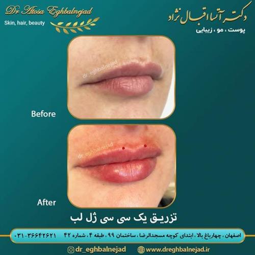 تزریق-ژل-لب-27