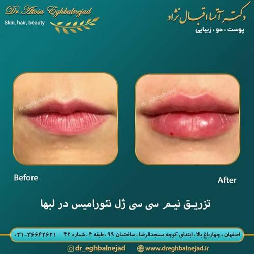 تزریق-ژل-لب-28