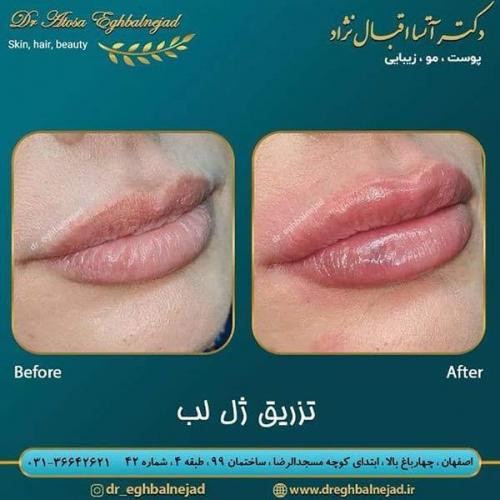 تزریق-ژل-لب-30