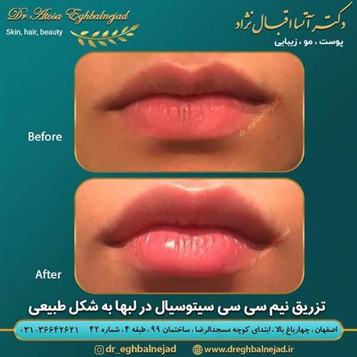 تزریق-ژل-لب-5