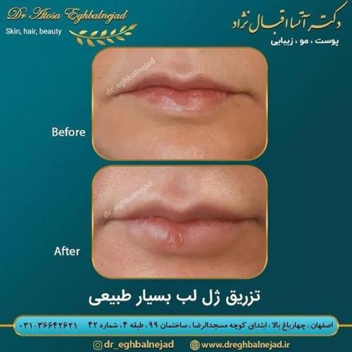 تزریق-ژل-لب-بسیار-طبیعی