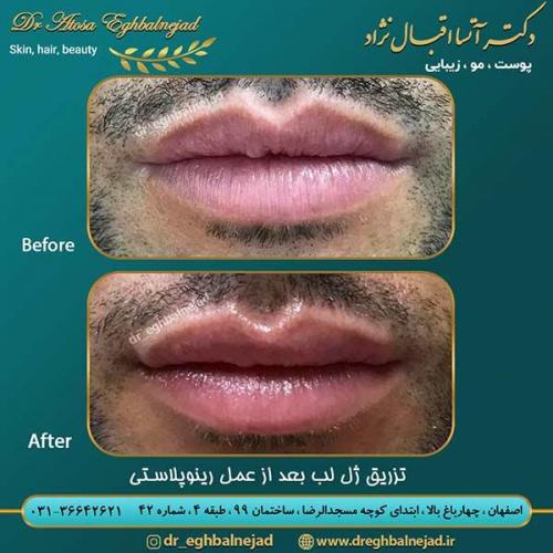 تزریق-ژل-لب-بعد-از-رینوپلاستی