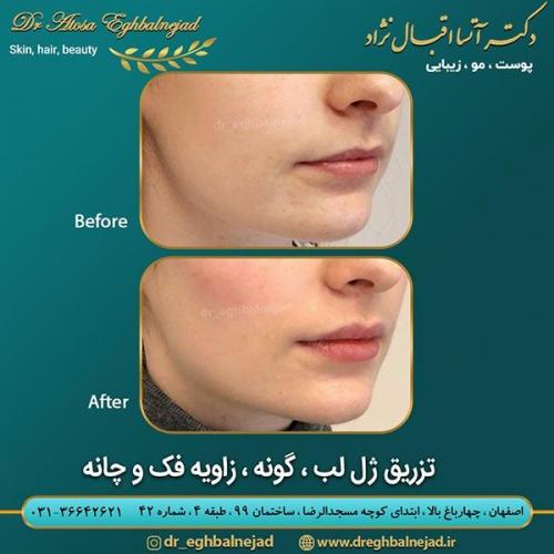 تزریق-ژل-لب-گونه-زاویه-فک-و-چانه