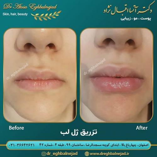 تزریق-ژل-لب