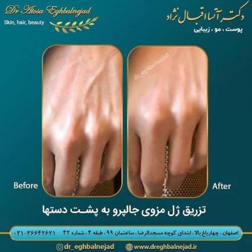 تزریق-ژل-مزوی-جالپرو-به-پشت-دستها