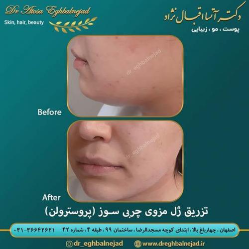تزریق-ژل-مزوی-چربی-سوز-1