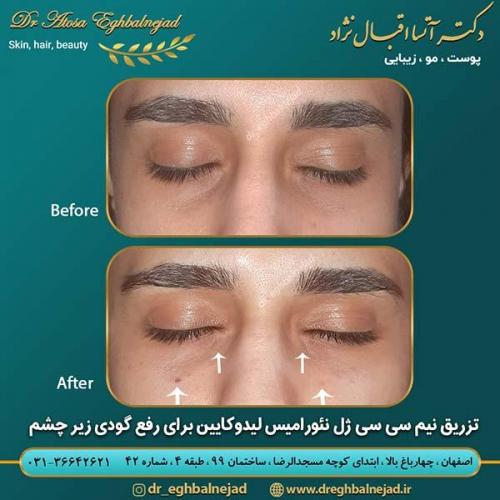 تزریق-ژل-نئورامیس-برای-رفع-گودی-زیر-چشم