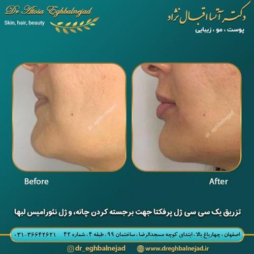 تزریق-ژل-پرفکتا-1