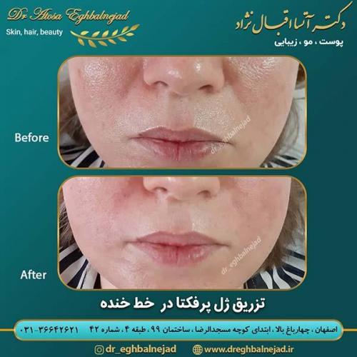 تزریق-ژل-پرفکتا-در-خط-خنده