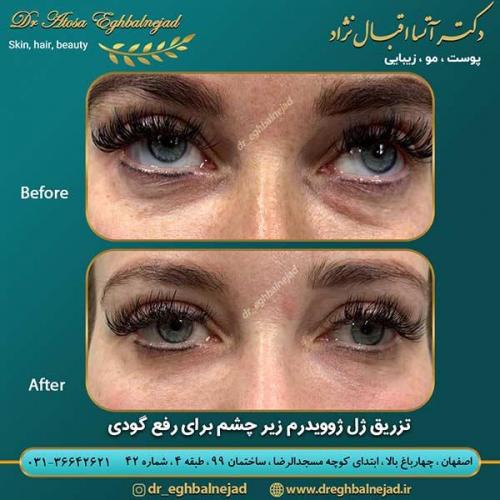 تزریق-ژل-ژوویدرم-1