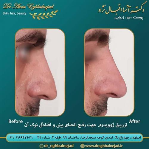 تزریق-ژوویدرم-جهت-رفع-انحنای-بینی-و-افتادن-نوک-آن