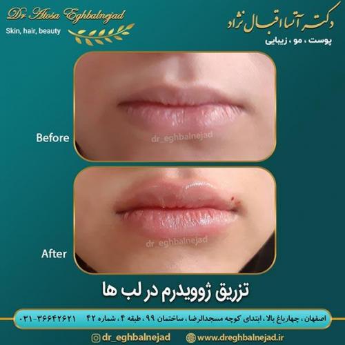 تزریق-ژوویدرم-در-لب-ها