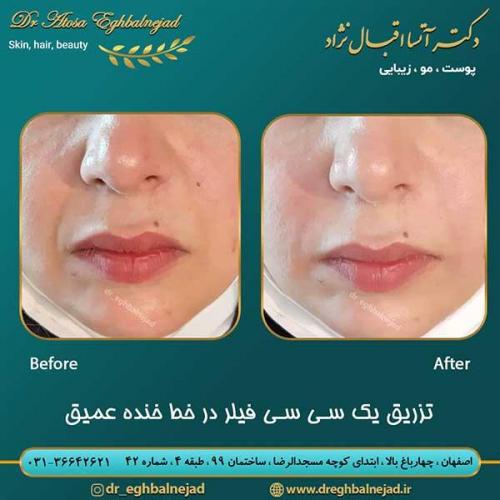 تزریق-یک-سی-سی-فیلر-در-خط-خنده-عمیق