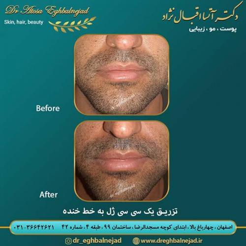تزریق-یک-سی-سی-ژل-به-خط-خنده