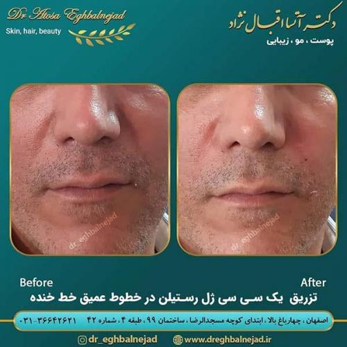 تزریق-یک-سی-سی-ژل-رستیلن-در-خطوط-عمیق-خط-خنده-1