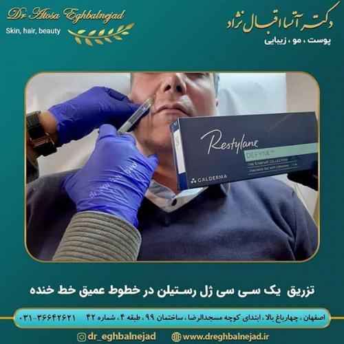 تزریق-یک-سی-سی-ژل-رستیلن-در-خطوط-عمیق-خط-خنده