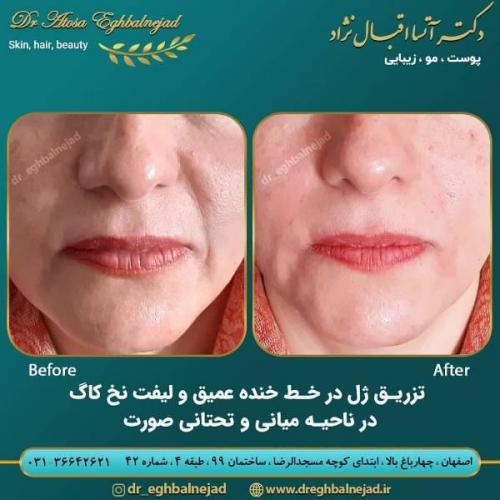 تزریق ژل 50 (1)