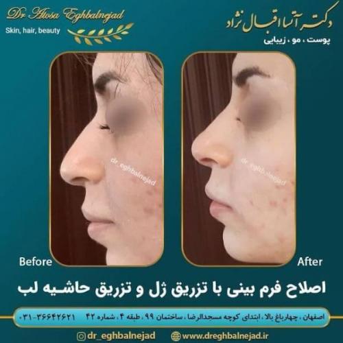 تزریق ژل 50 (10)