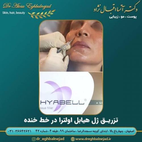 تزریق ژل 50 (11)