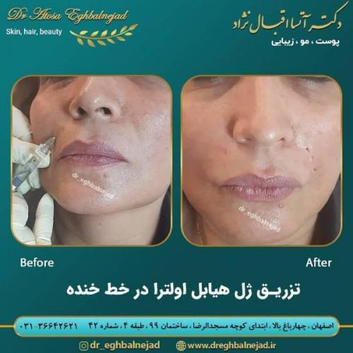 تزریق ژل 50 (12)