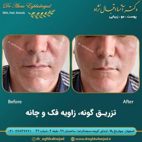 تزریق ژل 50 (13)