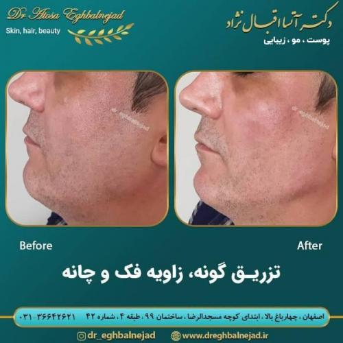تزریق ژل 50 (14)