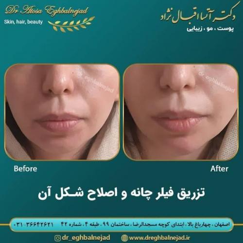 تزریق ژل 50 (15)