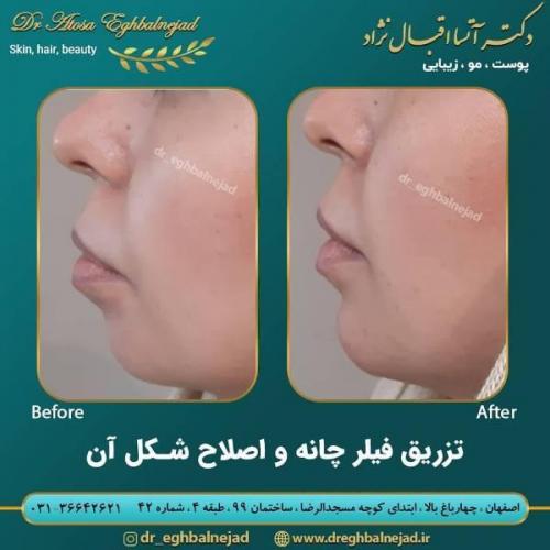 تزریق ژل 50 (16)