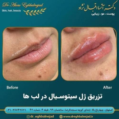 تزریق ژل 50 (17)