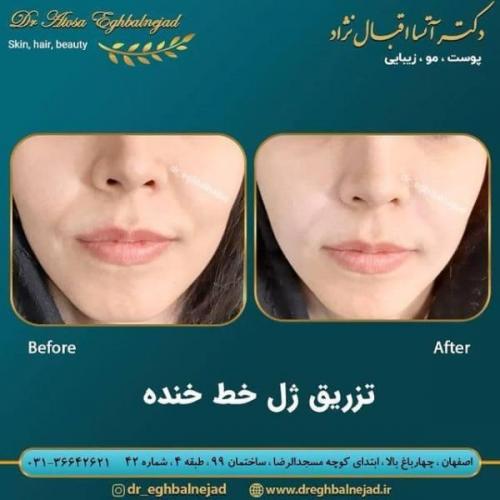 تزریق ژل 50 (18)
