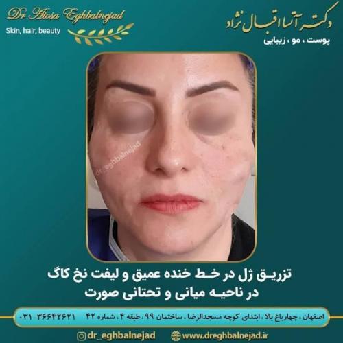 تزریق ژل 50 (2)