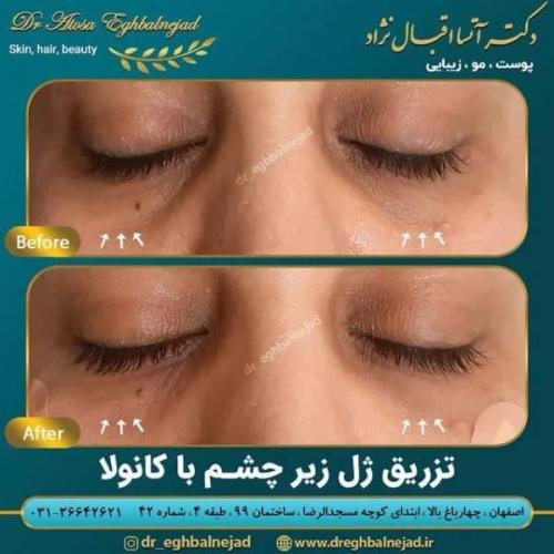 تزریق ژل 50 (3)