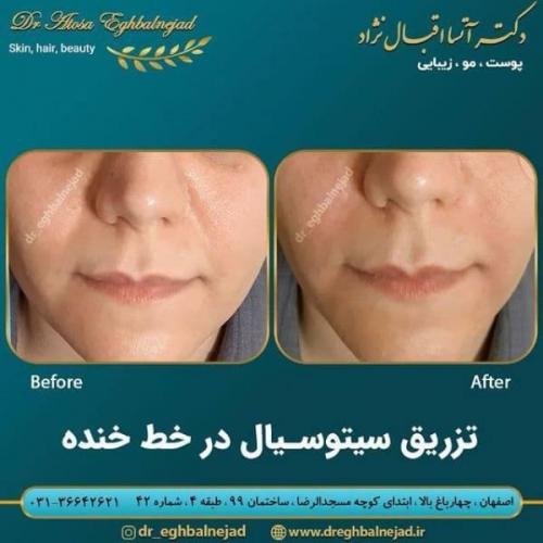 تزریق ژل 50 (4)
