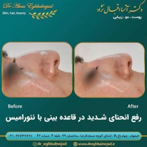 تزریق ژل 50 (5)