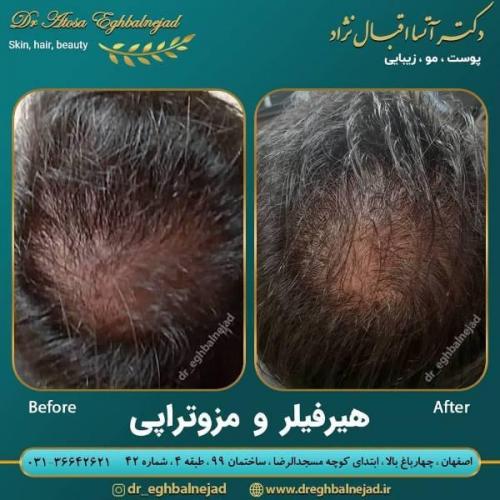 تزریق ژل 50 (6)
