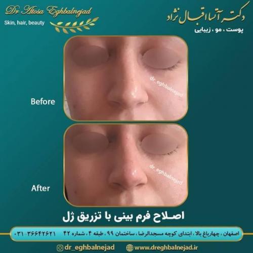 تزریق ژل 50 (7)