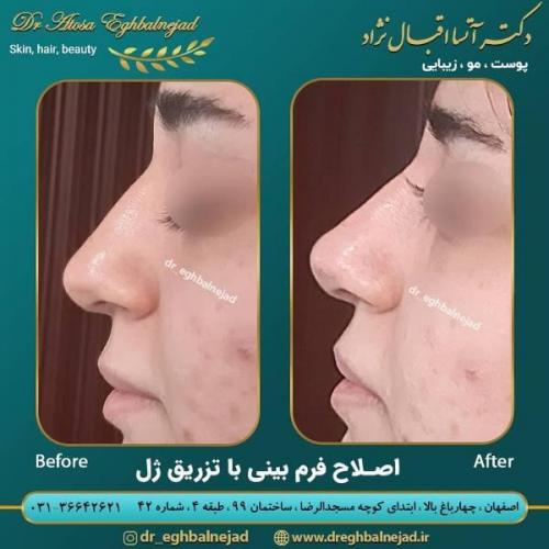 تزریق ژل 50 (8)