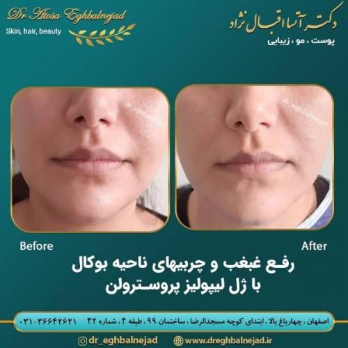 تزریق ژل 50 (9)