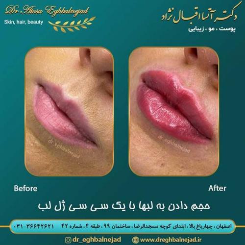 حجم-دادن-به-لبها-با-یک-سی-سی-ژل