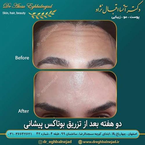 دو-هفته-بعد-از-تزریق-بوتاکس-پیشانی-1
