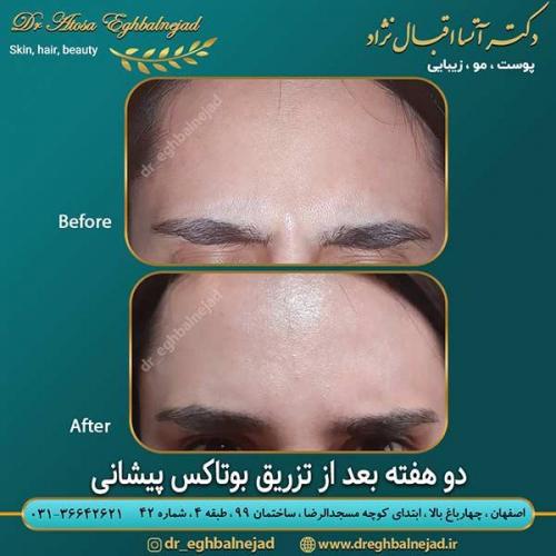 دو-هفته-بعد-از-تزریق-بوتاکس-پیشانی