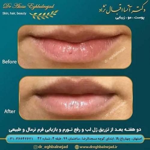 دو-هفته-بعد-از-تزریق-ژل-لب