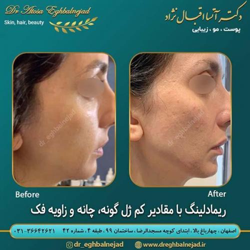 ریمادلینگ-با-مقدار-کم-ژل-گونه-چانه-و-زاویه-فک