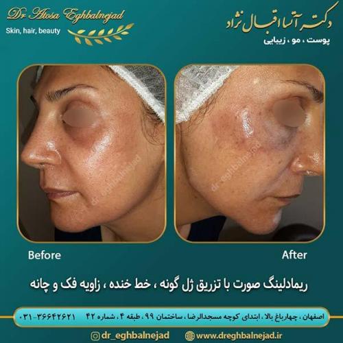 ریمادلینگ-صورت-با-تزریق-ژل-گونه-خط-خنده-و-زاویه-فک-و-چانه